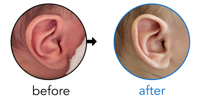 Before-and-after EarBuddies Conchal Crus result; started within the first month – Molly, Tyler & their Son Killian