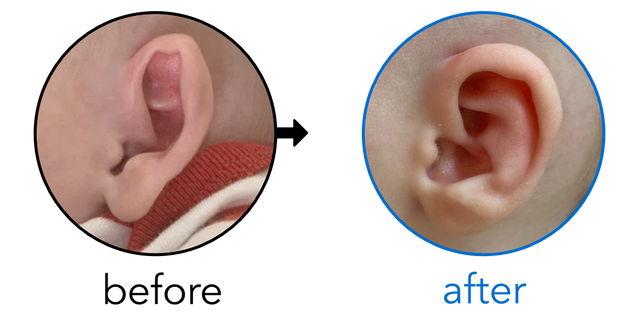 Before-and-after EarBuddies Stick-Out Ears result; started within the first month – Cristina & her Daughter