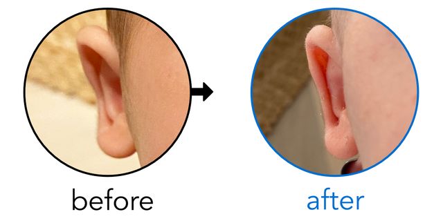 Before-and-after EarBuddies Stick-Out Ears result; started within the first month – Rachael & her son Adam