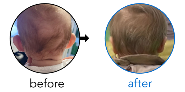 Before-and-after EarBuddies Stick-Out Ears result; started at 1–3 months – Magdalena & her son Oscar