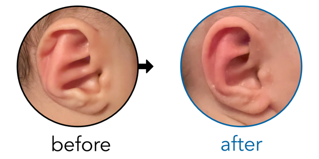 Before-and-after EarBuddies Rim Kink result; started at 1–3 months – Melissa & her daughter