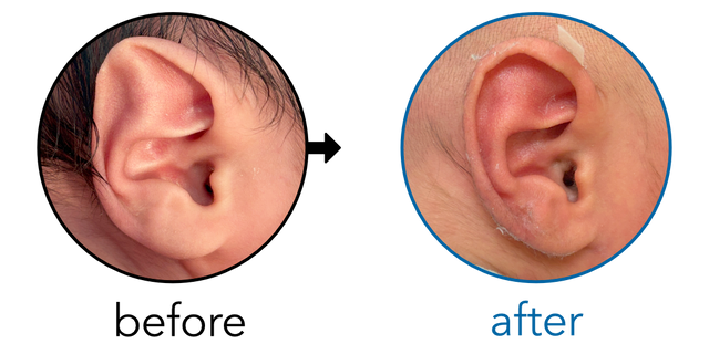 Before-and-after EarBuddies Stahl's Bar result; started within the first month – Keith Leung (Orthotist) & Baby Z