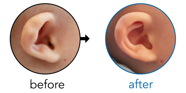 Before-and-after EarBuddies Cup Ear result; started at 1–3 months – Mrs. C & her Daughter Olivia
