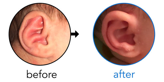 Before-and-after EarBuddies Conchal Crus result; started within the first month – Brittany, Jeremiah & their Daughter
