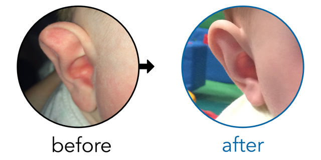 Before-and-after EarBuddies Stahl's Bar result; started at 3–6 months – Sarah P & Baby Harry