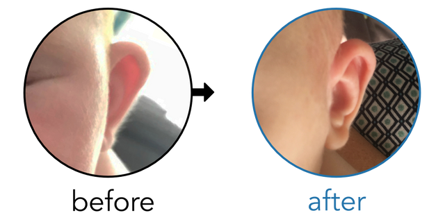 Before-and-after EarBuddies Stick-Out Ears result; started at 1–3 months – Jo & her Daughter Ettie