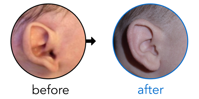 Before-and-after EarBuddies Stick-Out Ears result; started at 1–3 months – Pilar, Lars & their Son Laureano