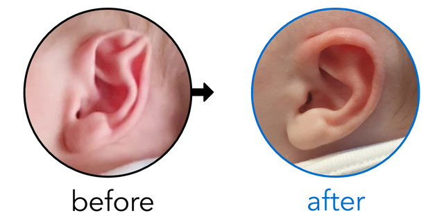 Before-and-after EarBuddies Stahl's Bar result; started at 1–3 months – Michelle & her son Tommy