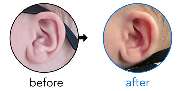 Before-and-after EarBuddies Conchal Crus result; started at 3–6 months – Lauren & her son