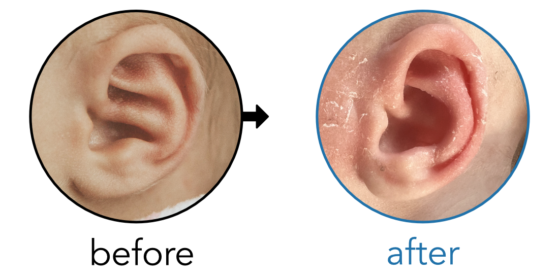 Before-and-after EarBuddies Conchal Crus result; started within the first month – Jada & her son