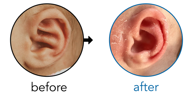 Before-and-after EarBuddies Conchal Crus result; started within the first month – Jada & her son