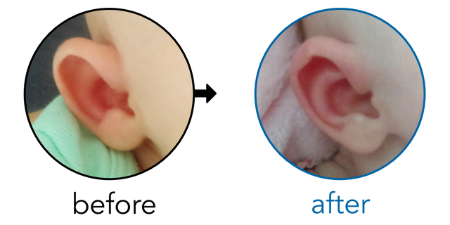 Before-and-after EarBuddies Stick-Out Ears result; started at 1–3 months – Elyse & her Daughter