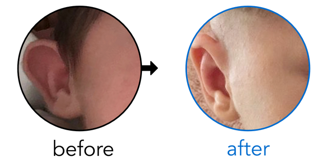 Before-and-after EarBuddies Stick-Out Ears result; started within the first month – Emma & her Daughter Polly