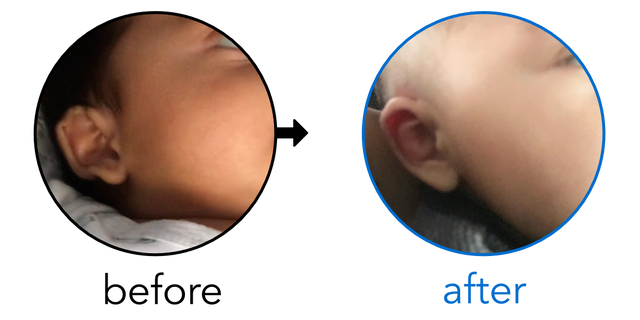 Before-and-after EarBuddies Stick-Out Ears result; started at 3–6 months – Doris & her Son Jacob