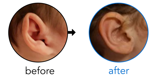 Before-and-after EarBuddies Stick-Out Ears result; started at 3–6 months – Keri & her Daughter
