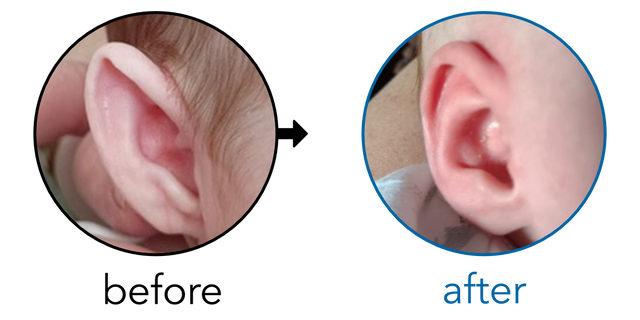 Before-and-after EarBuddies Stick-Out Ears result; started at 1–3 months – Karen & her daughter Charlotte