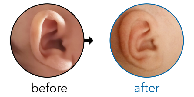 Before-and-after EarBuddies Stick-Out Ears result; started at 1–3 months – Nada & her son