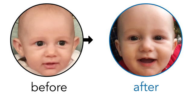 Before-and-after EarBuddies Stick-Out Ears result; started at 3–6 months – Amber & her Son Wolfie