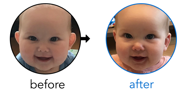 Before-and-after EarBuddies Stick-Out Ears result; started at 3–6 months – Kate & her Daughter Elise