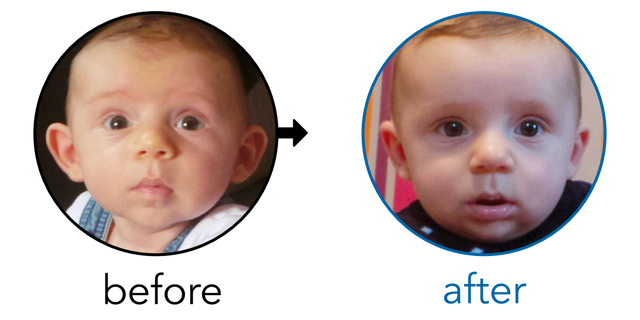 Before-and-after EarBuddies Stick-Out Ears result; started at 1–3 months – Ruth & her son Clark