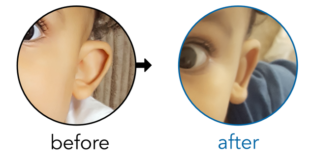 Before-and-after EarBuddies Stick-Out Ears result; started at 6–12 months – Annabel & her Son