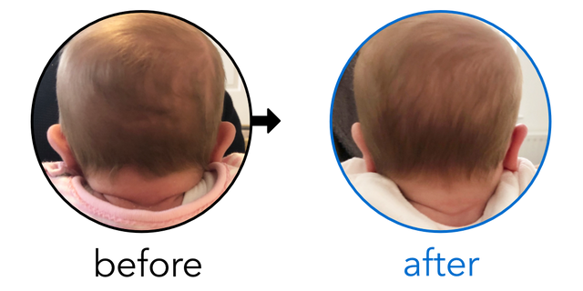Before-and-after EarBuddies Stick-Out Ears result; started within the first month – Emily & her Daughter Olivia