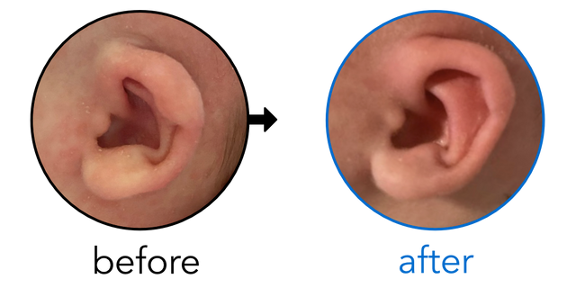 Before-and-after EarBuddies Lop Ear result; started at 1–3 months – Chandler & her Daughter