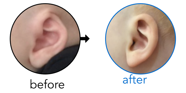 Before-and-after EarBuddies Cryptotia result; started at 3–6 months – Hadley, Josh & their son Boden