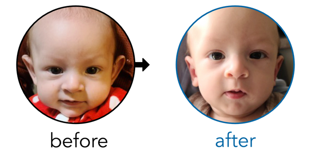 Before-and-after EarBuddies Stick-Out Ears result; started at 1–3 months – Mr. Lopez & his son
