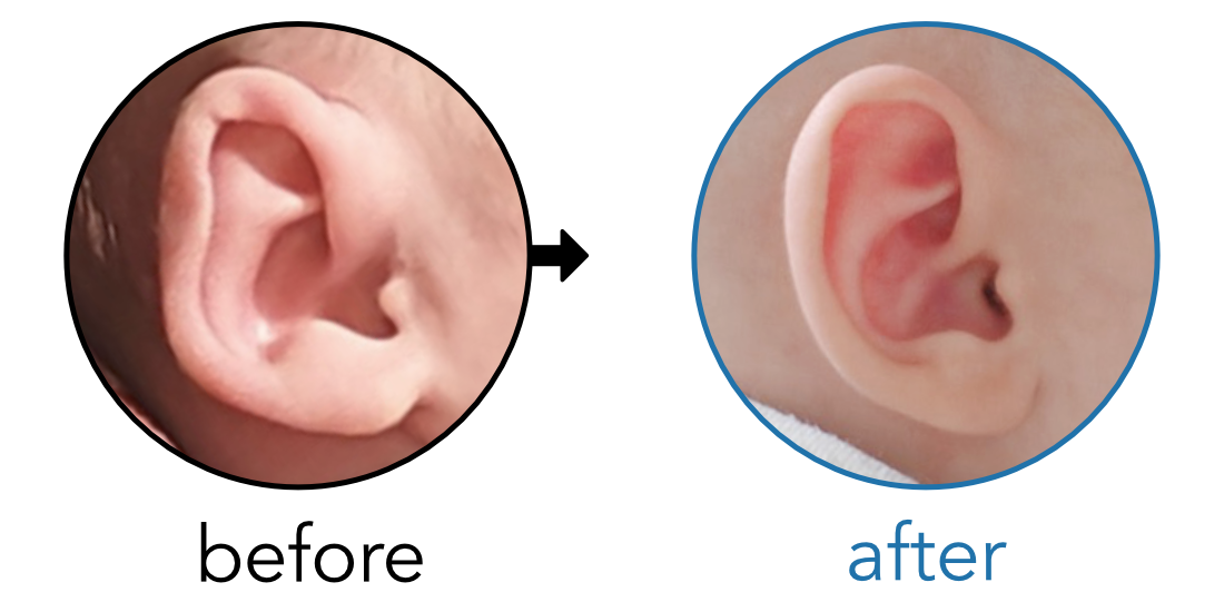 Before-and-after EarBuddies Folded-Over Helical Rim result; started within the first month – Dora & her daughter