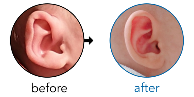 Before-and-after EarBuddies Folded-Over Helical Rim result; started within the first month – Dora & her daughter