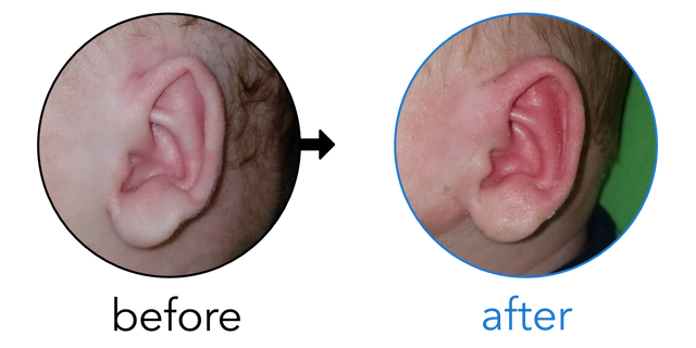 Before-and-after EarBuddies Folded-Over Helical Rim result; started at 1–3 months – Jacquelyn & her Son