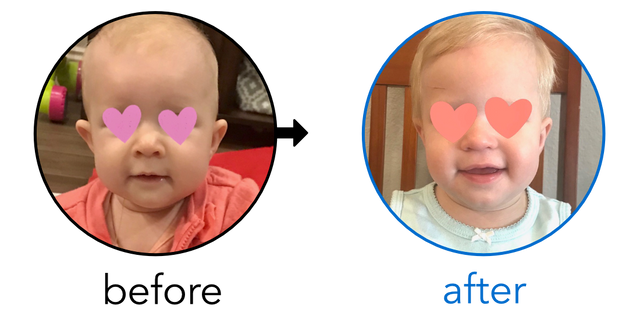 Before-and-after EarBuddies Stick-Out Ears result; started at 6–12 months – Joanna & her Daughter Amelia
