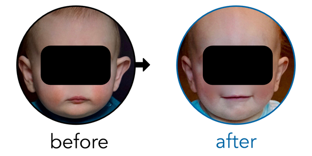 Before-and-after EarBuddies Stick-Out Ears result; started at 6–12 months – Dr. Kristen H. & her Baby Son