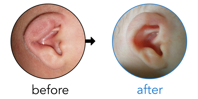 Before-and-after EarBuddies Lop Ear result; started within the first month – Laura & her Son George
