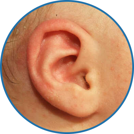 Ear Condition Type