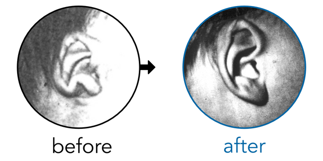 Before-and-after EarBuddies Stick-Out Lobe result; started at 1–3 months – Mrs J. & her son Howard