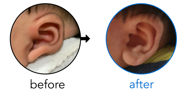 Before-and-after EarBuddies Stick-Out Lobe result; started at 3–6 months – Rhea & her Daughter Maisie Rose