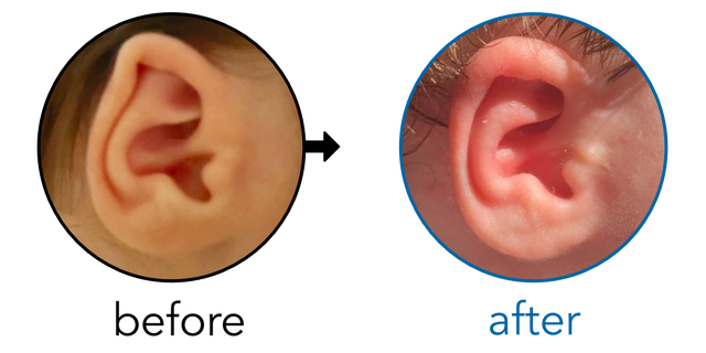 Before-and-after EarBuddies Folded-Over Helical Rim result; started at 1–3 months – Jessica L
