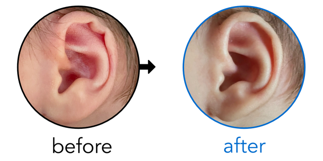 Before-and-after EarBuddies Rim Kink result; started within the first month – Stacy & her son Mason