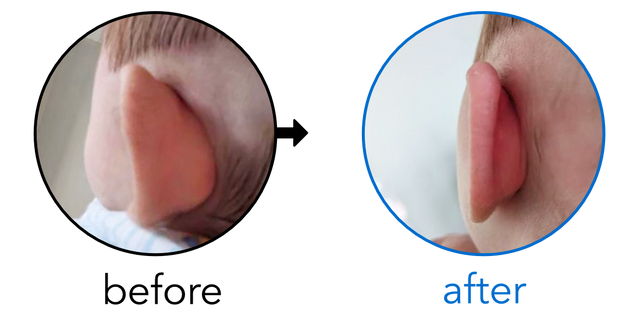 Before-and-after EarBuddies Stick-Out Ears result; started at 1–3 months – Loretta & her baby