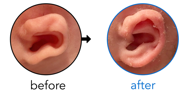 Before-and-after EarBuddies Stick-Out Ears result; started at 1–3 months – Coady & her son Jude